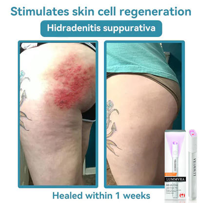 ✨ Lummvra™ All-in-One CO₂ Laser Eraser Pen | Removes Moles, Warts, Skin Flaws & Pigmentation