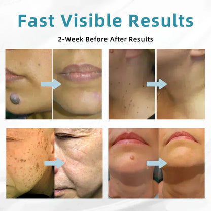 ✨ Lummvra™ All-in-One CO₂ Laser Eraser Pen | Removes Moles, Warts, Skin Flaws & Pigmentation