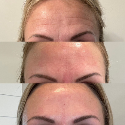 Lummvra® 10-in-1 Advanced Nano Microneedle Patches